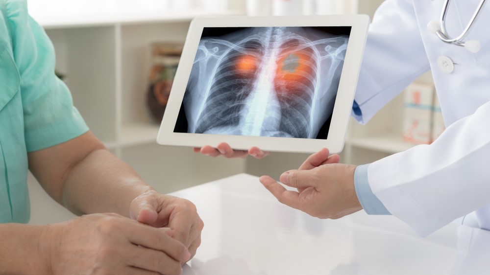 Iovance looks to advance its non-small cell lung cancer therapy