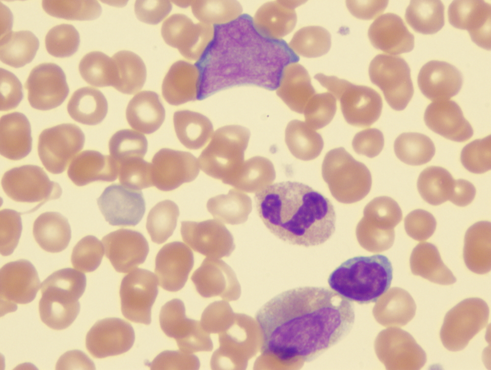 GSK’s Ojjaara receives FDA approval for treating myelofibrosis patients with anaemia