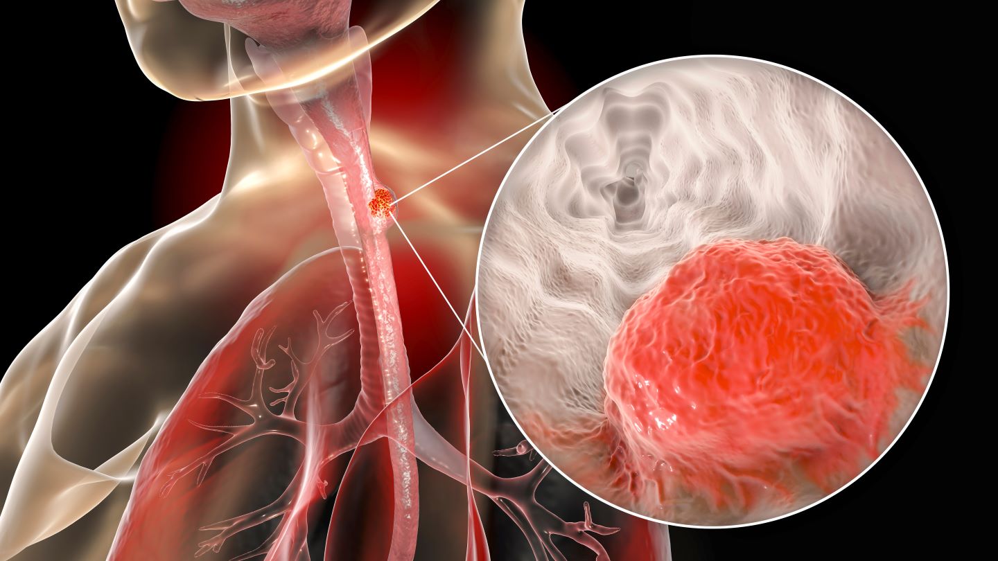 FDA approves BeiGene’s TEVIMBRA for oesophageal cancer