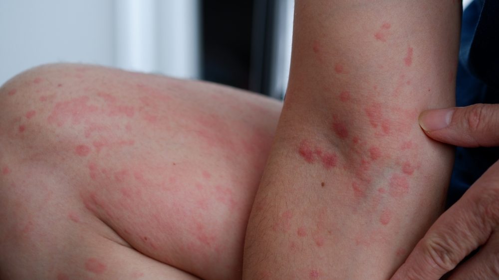 FDA reviews Sanofi and Regeneron’s Dupixent label expansion for urticaria 