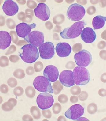 leukaemia