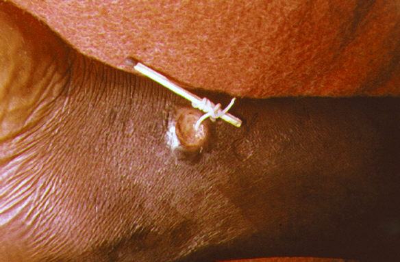 Guinea worm disease