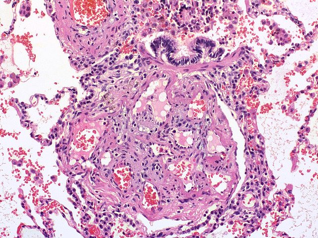 Image: A view of a plexiform lesion  showing pulmonary hypertension. Photo courtesy of Wikipedia.